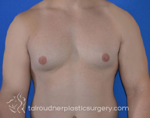 Male Breast Reduction (Gynecomastia)
