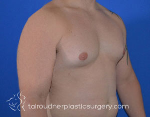 Male Breast Reduction (Gynecomastia)