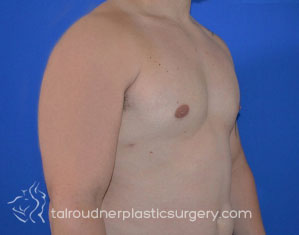 Male Breast Reduction (Gynecomastia)