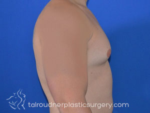Male Breast Reduction (Gynecomastia)