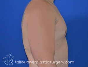 Male Breast Reduction (Gynecomastia)
