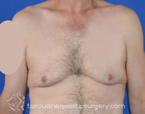 Male Breast Reduction (Gynecomastia)
