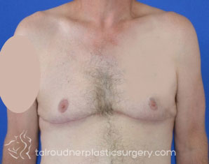 Male Breast Reduction (Gynecomastia)