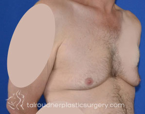Male Breast Reduction (Gynecomastia)
