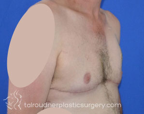 Male Breast Reduction (Gynecomastia)