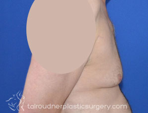 Male Breast Reduction (Gynecomastia)