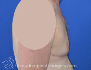 Male Breast Reduction (Gynecomastia)