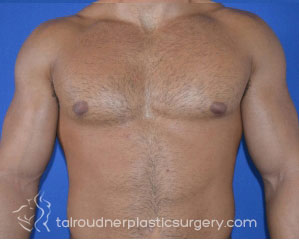 Male Breast Reduction (Gynecomastia)