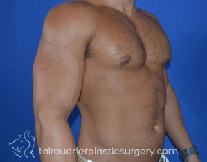 Male Breast Reduction (Gynecomastia)