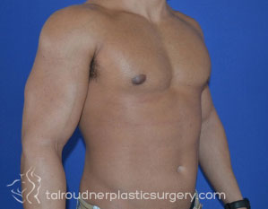 Male Breast Reduction (Gynecomastia)