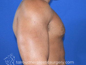 Male Breast Reduction (Gynecomastia)