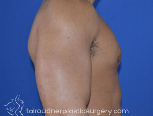 Male Breast Reduction (Gynecomastia)