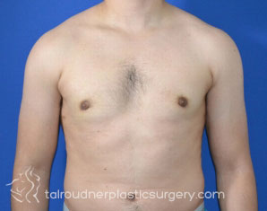 Male Breast Reduction (Gynecomastia)