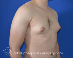Male Breast Reduction (Gynecomastia)