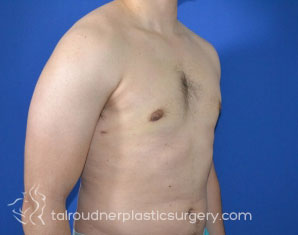 Male Breast Reduction (Gynecomastia)