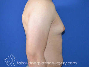 Male Breast Reduction (Gynecomastia)