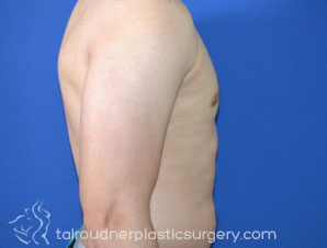 Male Breast Reduction (Gynecomastia)