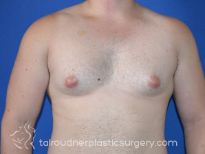 Male Breast Reduction (Gynecomastia)