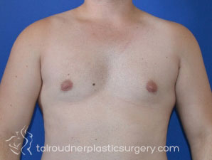 Male Breast Reduction (Gynecomastia)