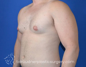 Male Breast Reduction (Gynecomastia)