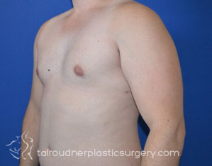 Male Breast Reduction (Gynecomastia)