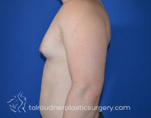 Male Breast Reduction (Gynecomastia)
