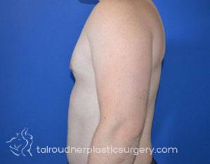 Male Breast Reduction (Gynecomastia)