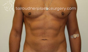 Male Liposuction