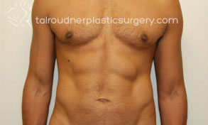 Male Liposuction