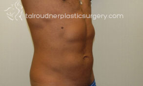 Male Liposuction