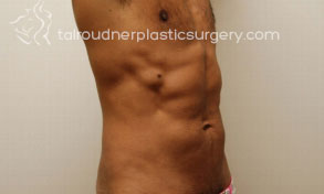 Male Liposuction