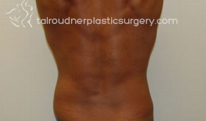 Male Liposuction