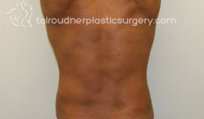 Male Liposuction