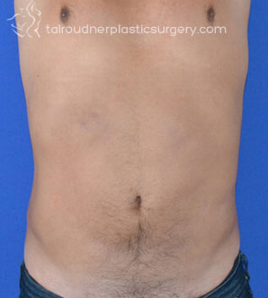Male Liposuction