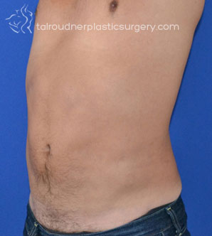 Male Liposuction