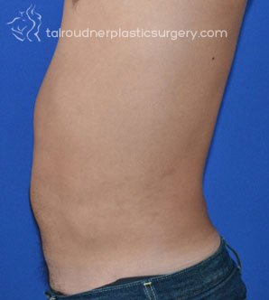 Male Liposuction