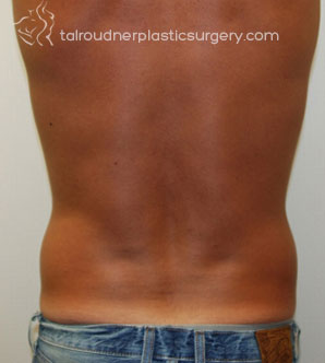 Male Liposuction