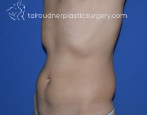 Male Liposuction