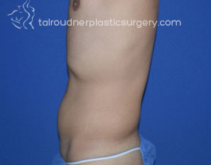 Male Liposuction