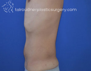 Male Liposuction
