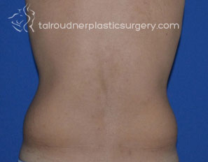 Male Liposuction