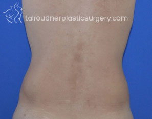 Male Liposuction