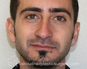 Male Rhinoplasty