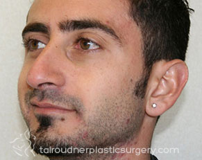Male Rhinoplasty