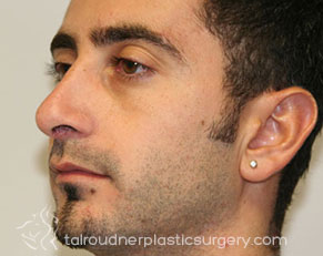 Male Rhinoplasty