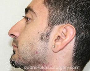 Male Rhinoplasty