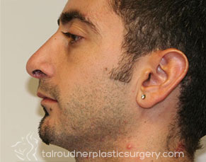 Male Rhinoplasty