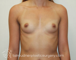 Breast Augmentation