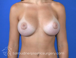 Breast Augmentation