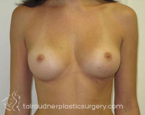Breast Augmentation